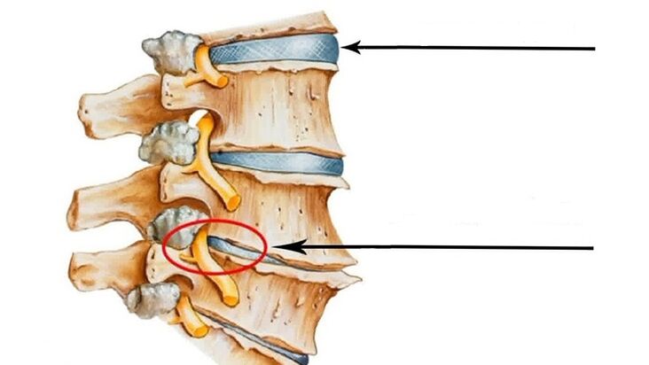 kecederaan tulang belakang sekiranya berlaku osteochondrosis serviks