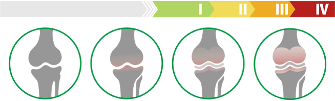 Tahap klinikal arthrosis sendi lutut (tahap arthrosis sendi lutut)