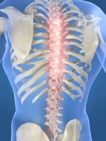 lesi tulang belakang sekiranya berlaku osteochondrosis toraks