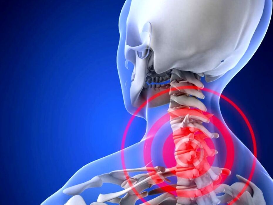sakit leher dengan osteochondrosis