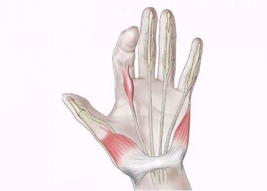 keradangan tendon sebagai punca sakit pada sendi jari