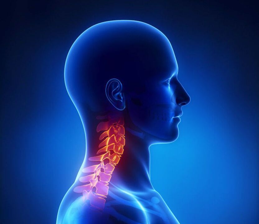 Osteochondrosis serviks adalah patologi tulang belakang, yang boleh anda singkirkan di rumah