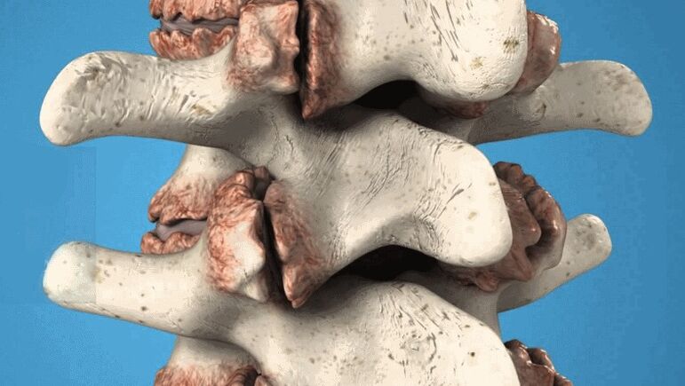 osteofit tulang belakang sebagai punca sakit pinggang
