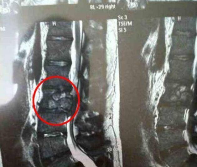 tumor tulang belakang sebagai punca sakit belakang
