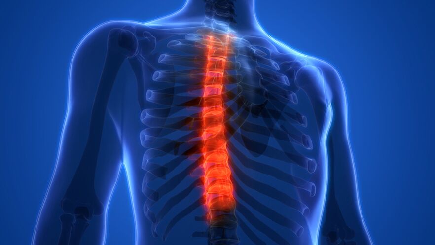 Osteochondrosis tulang belakang toraks, dicirikan oleh pemusnahan cakera intervertebral