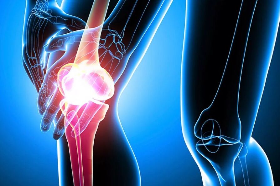 Arthrosis lutut