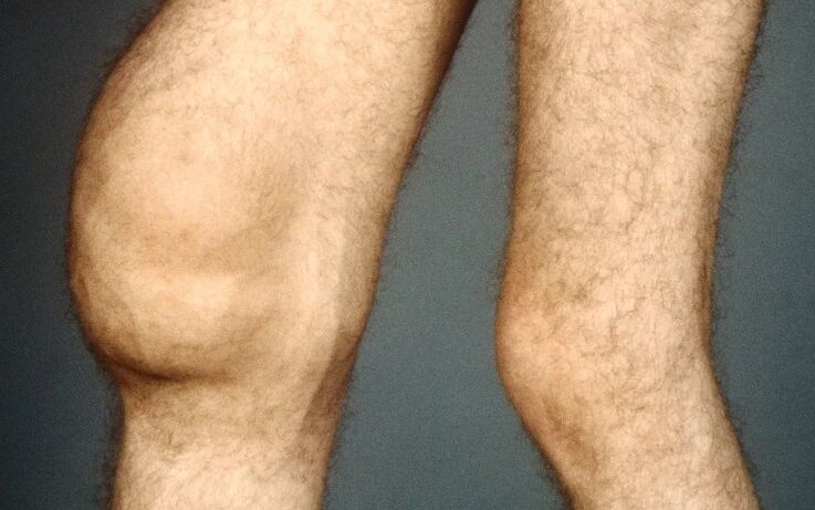 Post -traumatic Arthrosis dari sendi lutut