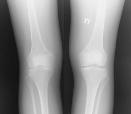 Radiografi sendi lutut