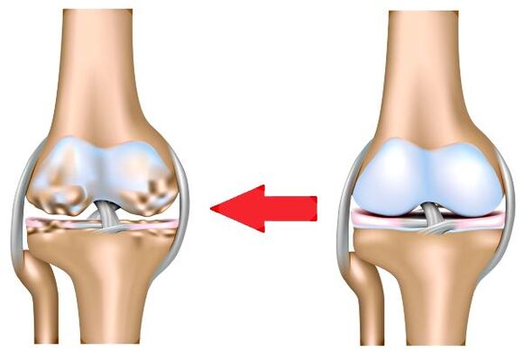 Bersama dan arthrosis yang sihat