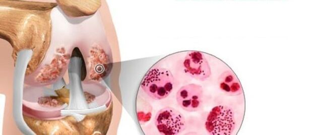 yang membawa kepada perkembangan arthrosis
