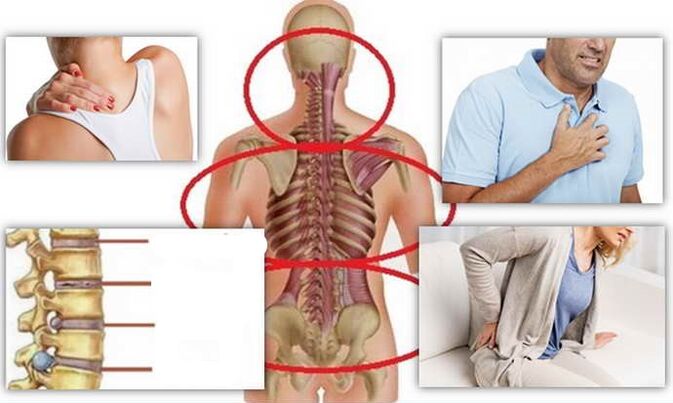 Tempat penyakit untuk osteochondrosis