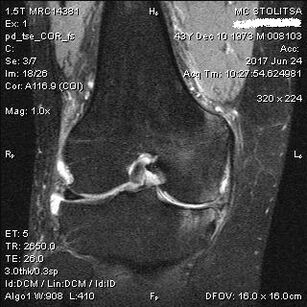Osteoarthritis sendi lutut pada MRI