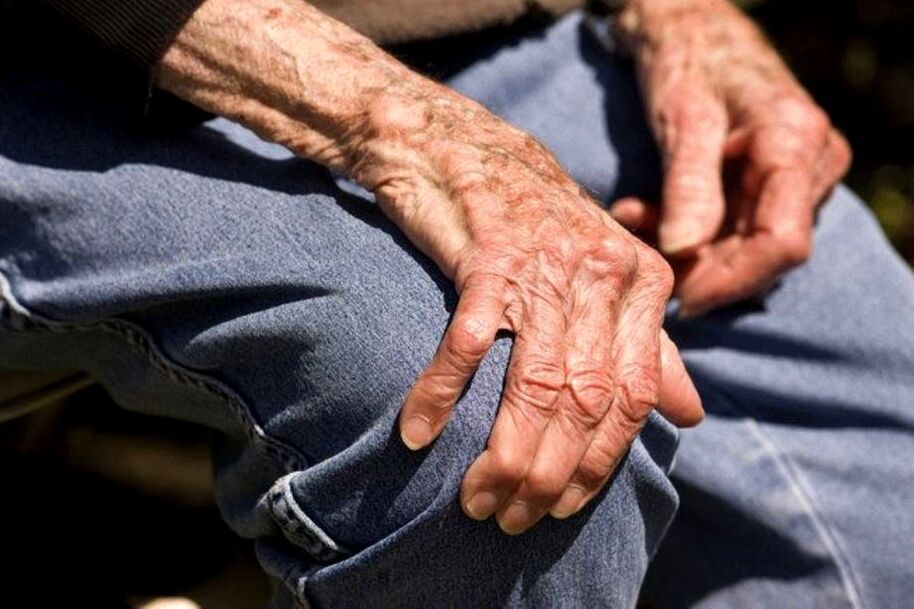 Arthrosis adalah penyakit berkaitan usia yang berlaku pada orang yang lebih tua